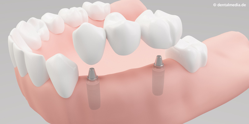 Implantat Ebstorf