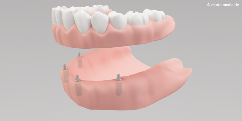 Zahnarzt Implantate Ebstorf